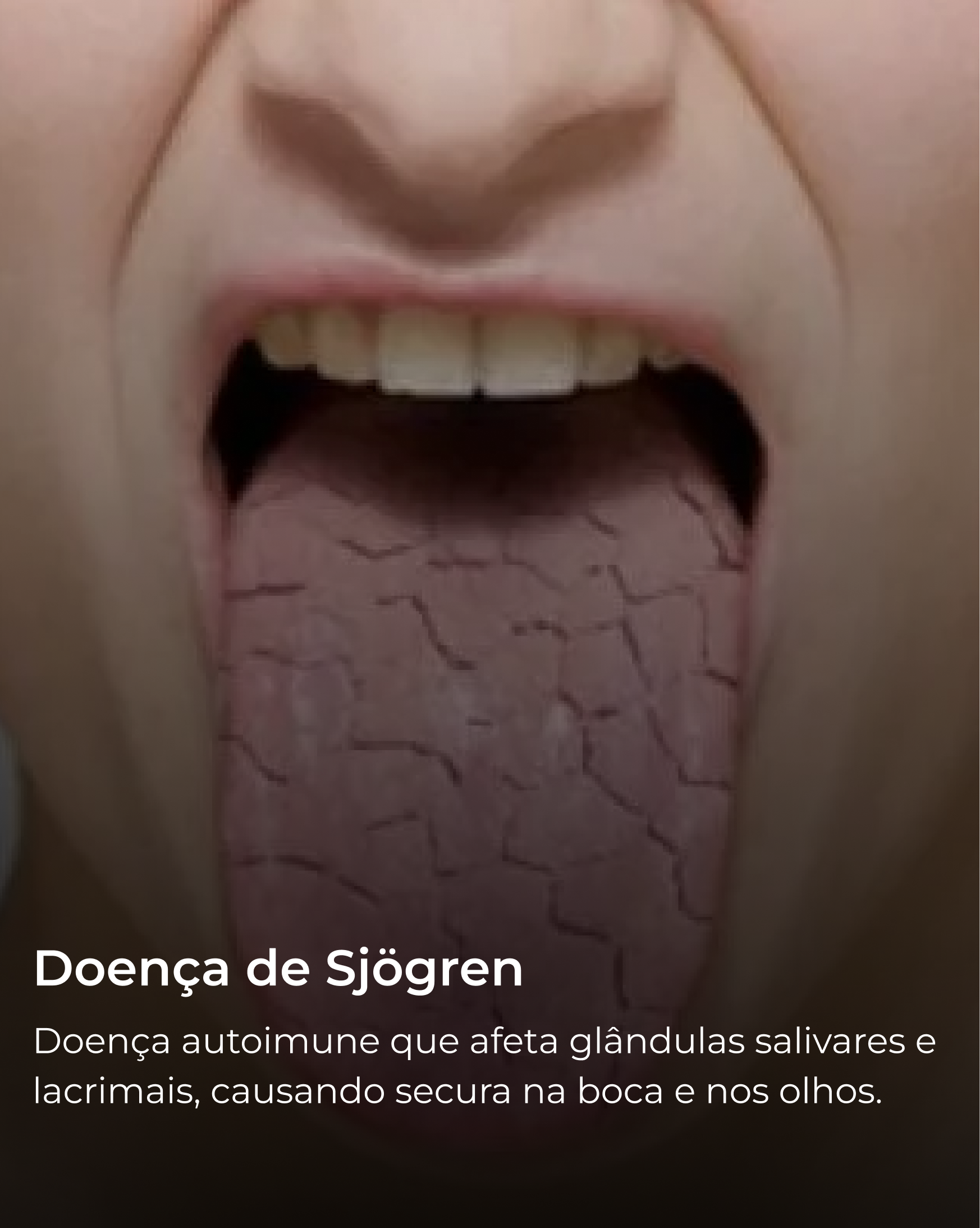 Doença de Sjögren