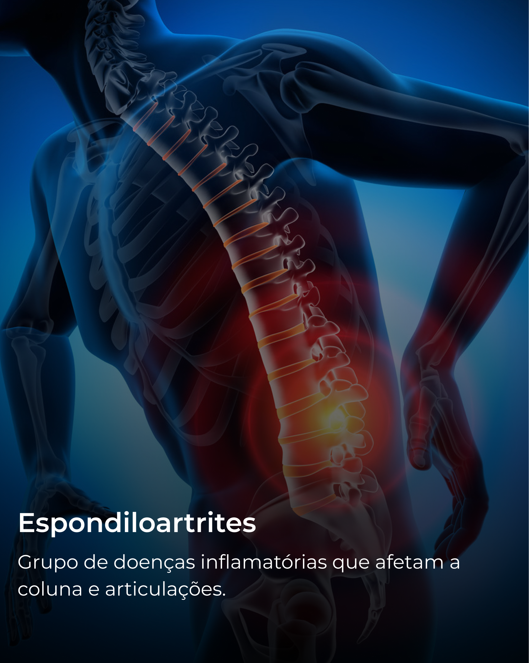 Espondiloartrites