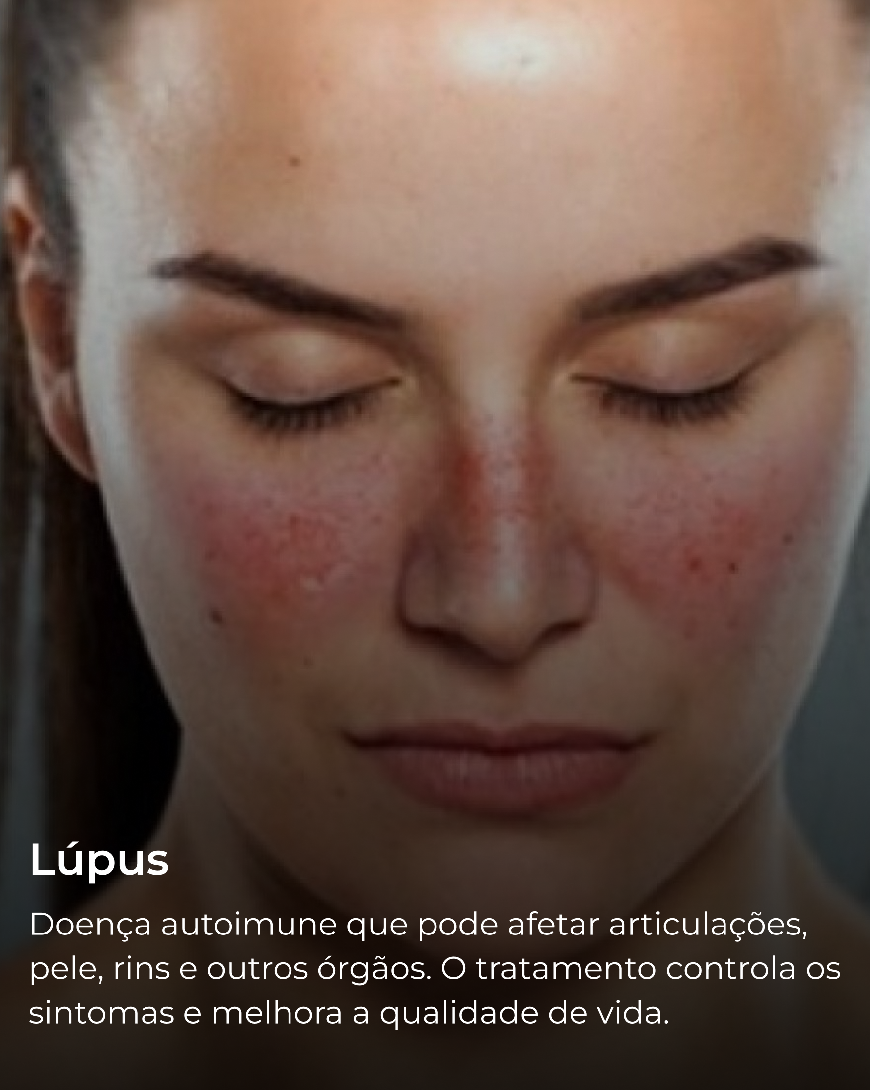Lúpus