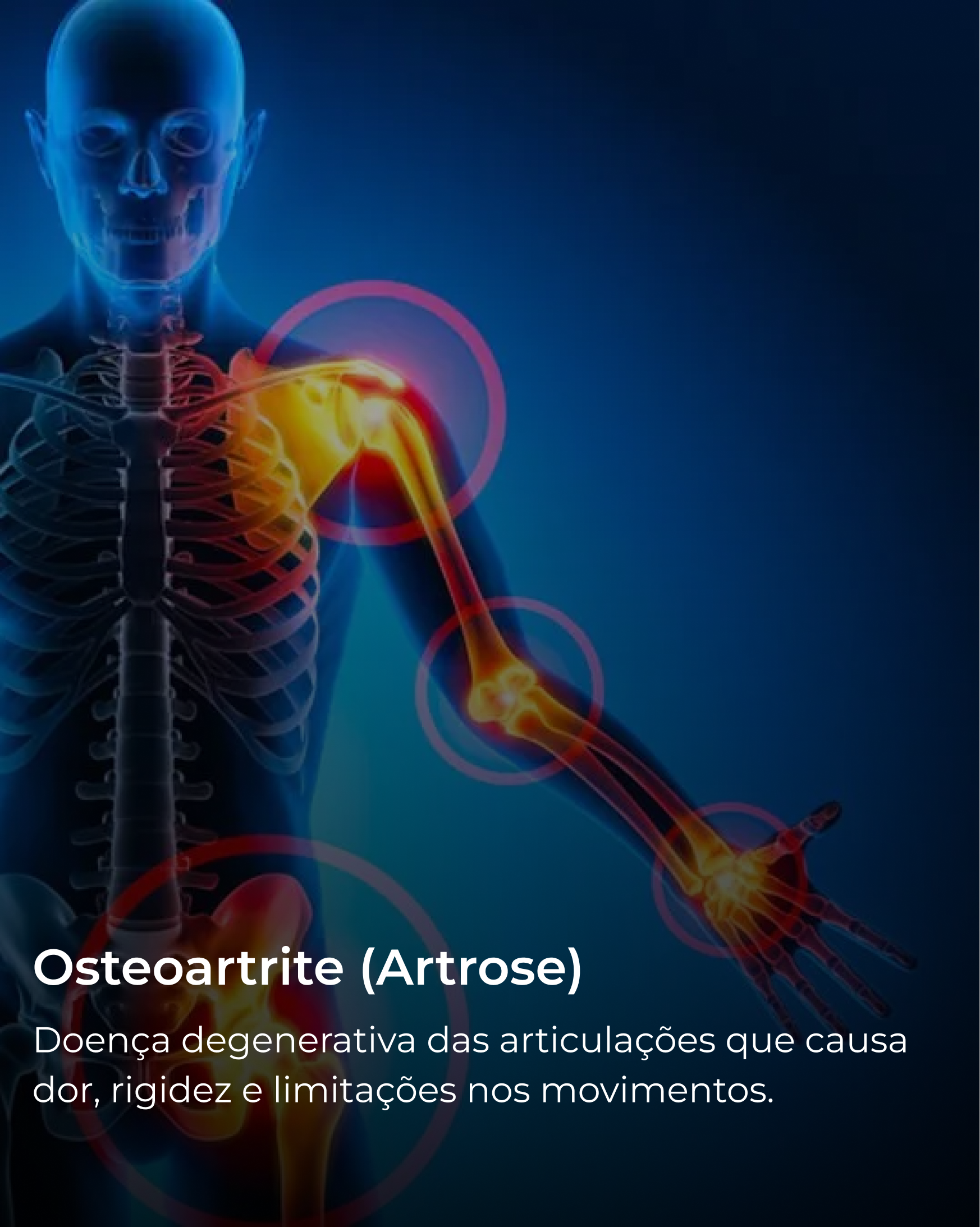 Osteoartrite (Artrose)