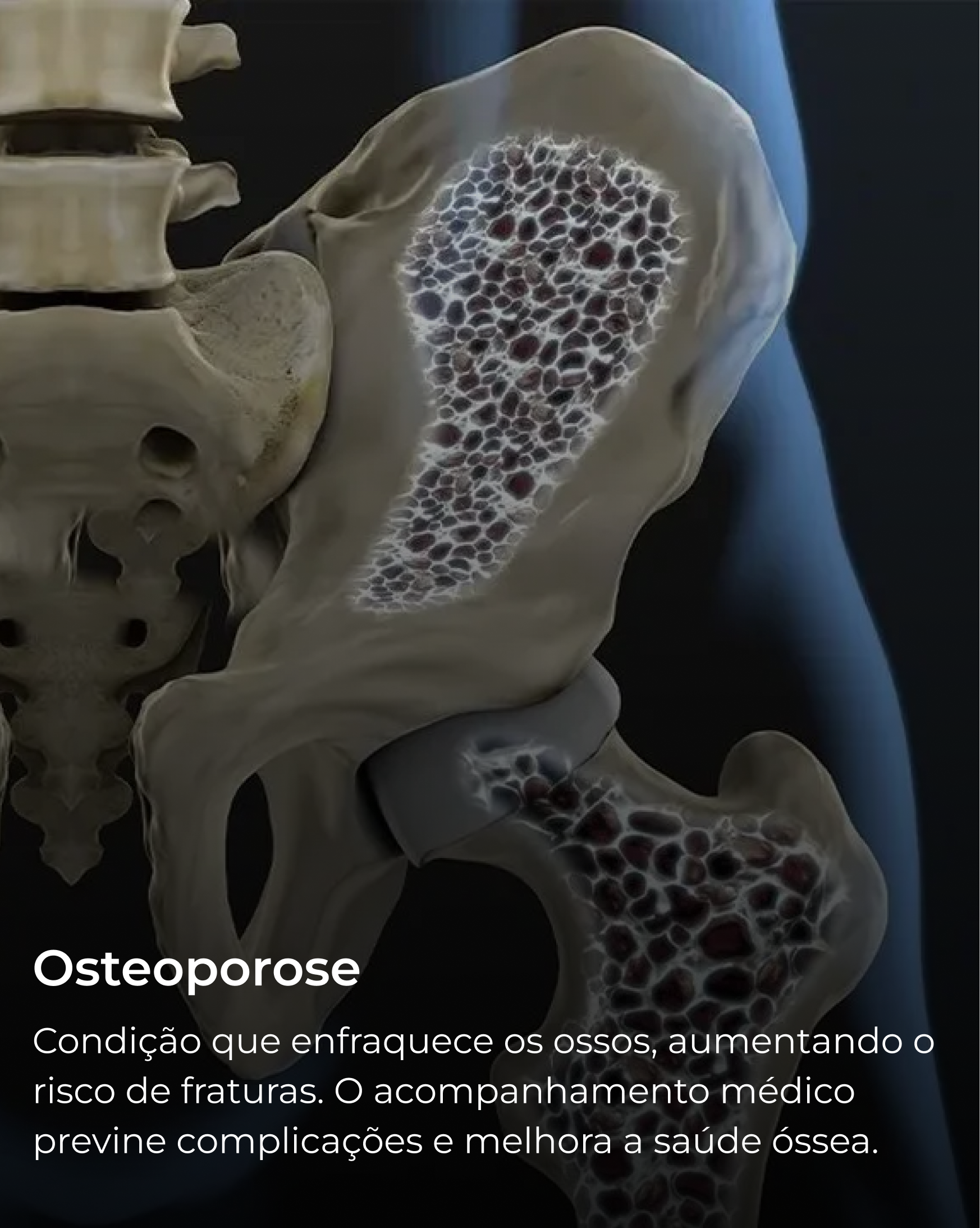 Osteoporose