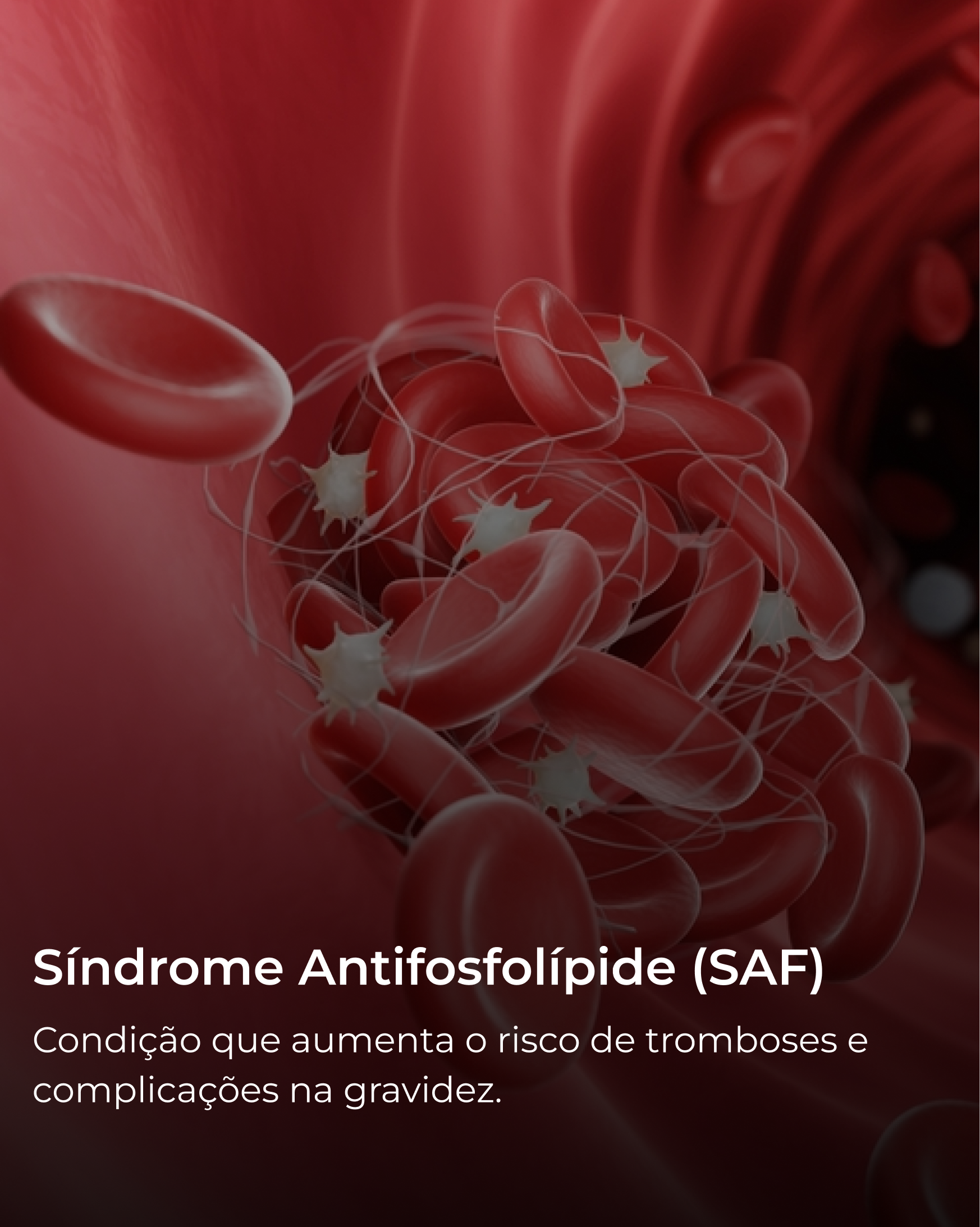 Síndrome Antifosfolípide (SAF)