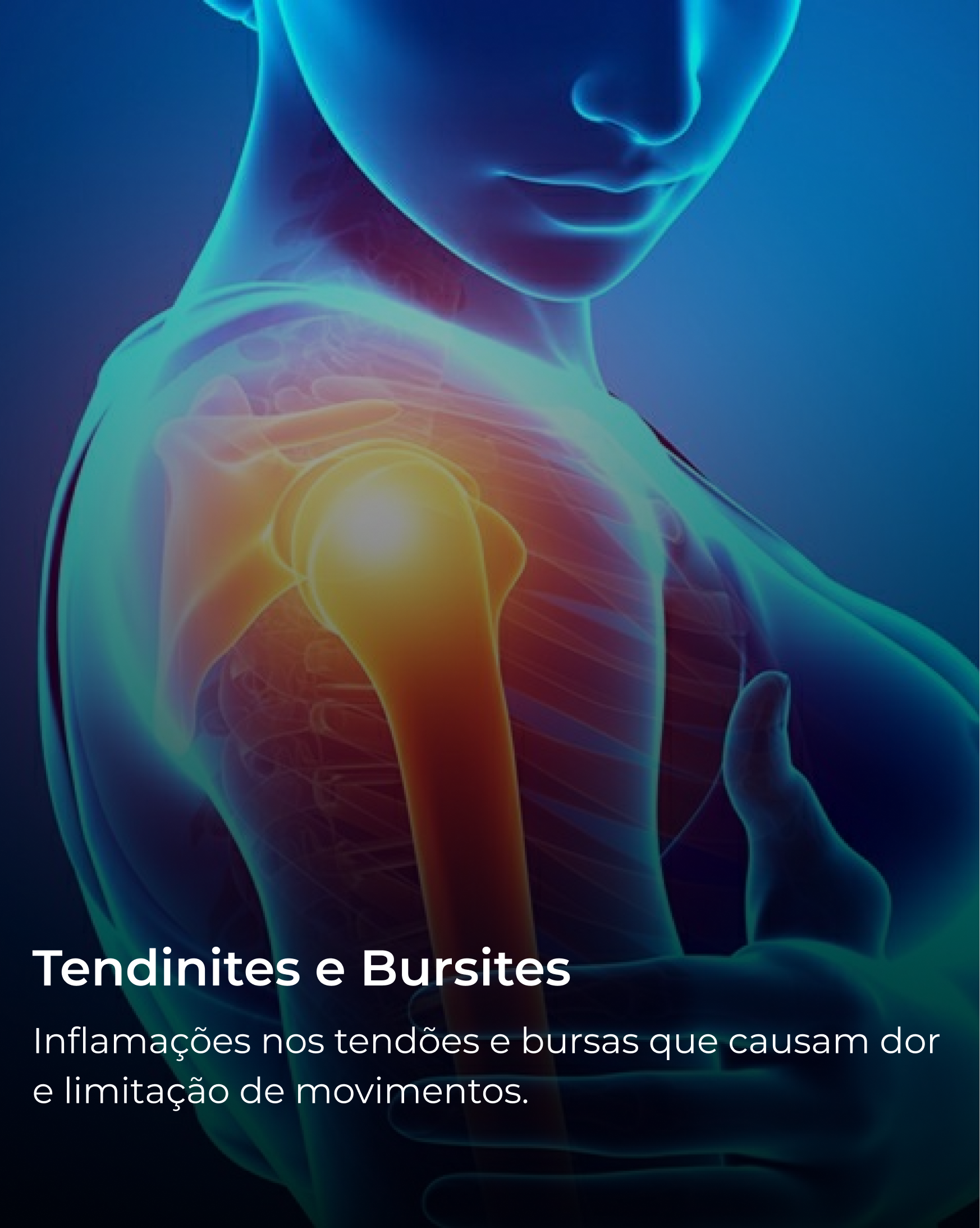 Tendinites e Bursites